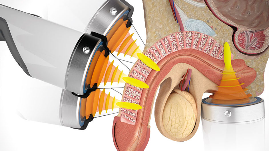 Portable Electric Focused Shockwave Therapy Machine For ED